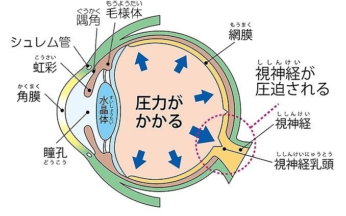 緑内障と眼圧